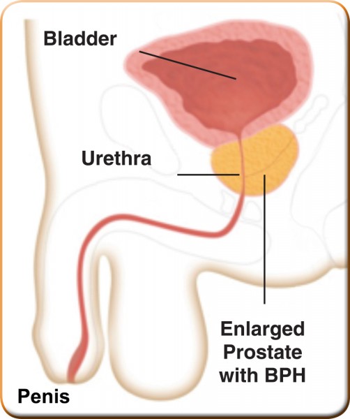 Enlarged_Prostate
